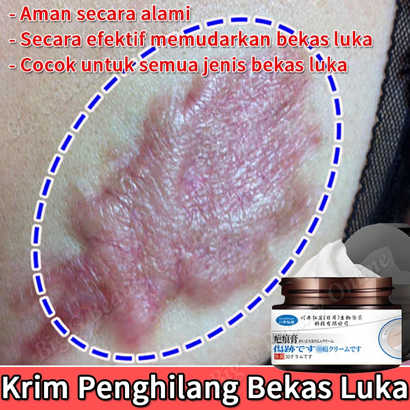 Jual Krim Penghilang Bekas Luka Hitam Koreng Penghilang Bekas Cacar
