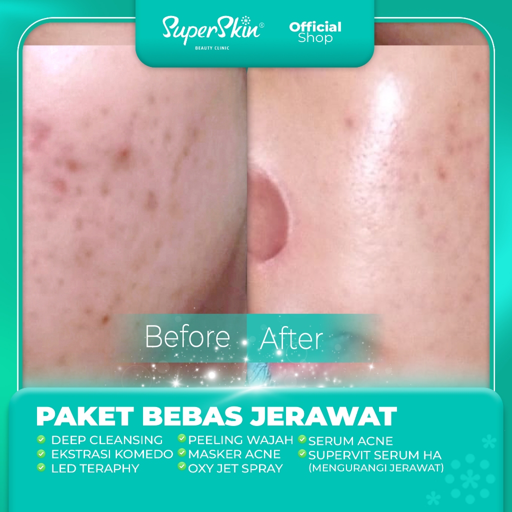 Produk Superskinme | Shopee Indonesia