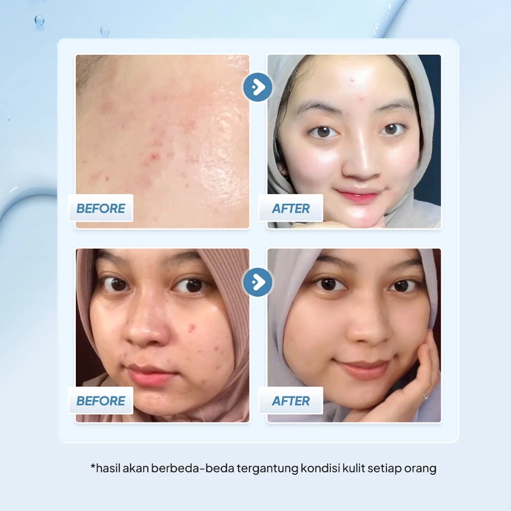 Gel Pelembab Mplora 8+ Ceramide untuk Kulit Kering, Kombinasi, dan Rentan Jerawat