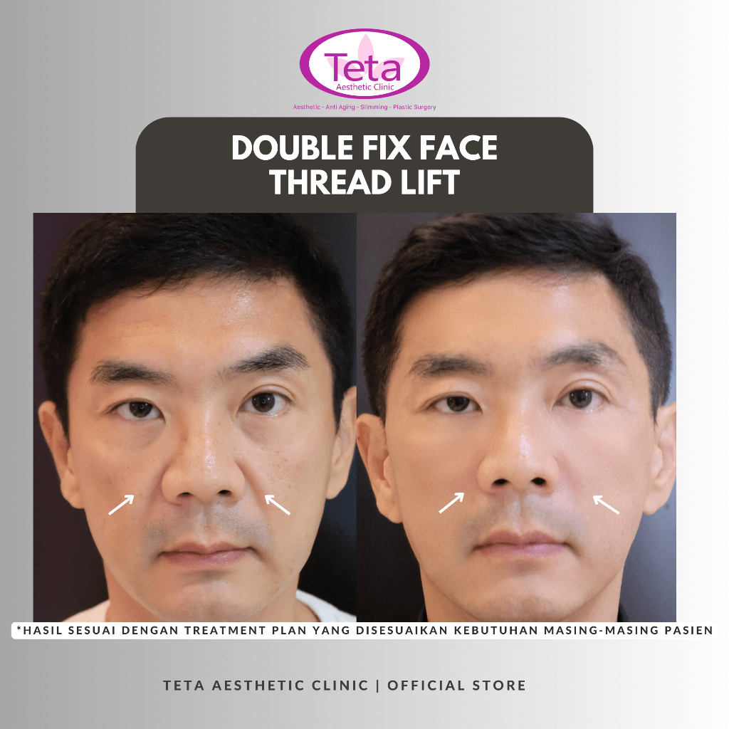 Jual TETA Face Thread Lift by Double Fix Pyramid | Shopee Indonesia