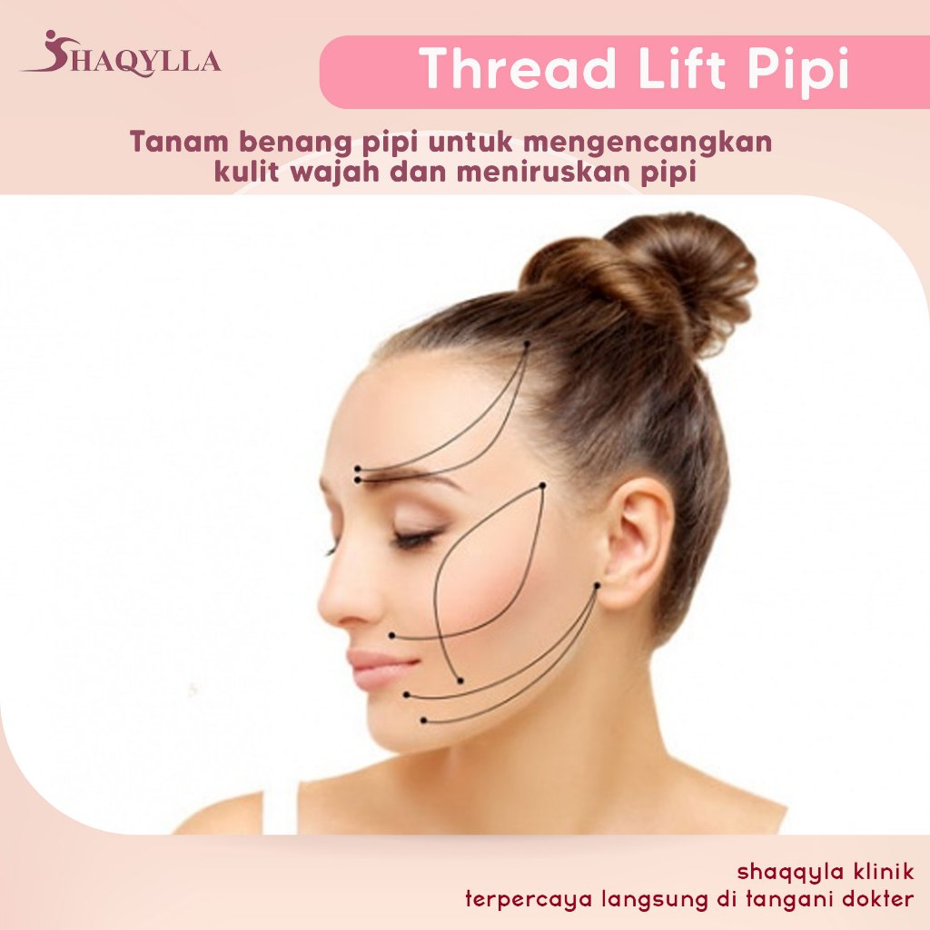 Jual Shaqylla Treatment Perawatan Thread Lift Tanam Benag Pipi Wajah ...