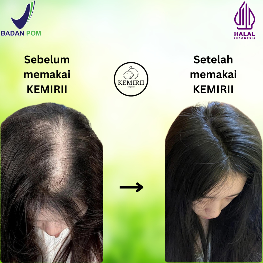 Jual Minyak Kemiri Bakar Murni Penumbuh Rambut 100 ml Alami Original ...