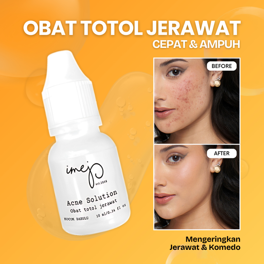 Jual IMEJ Obat Totol jerawat dengan Sulfur dan Salicylic Acid untuk