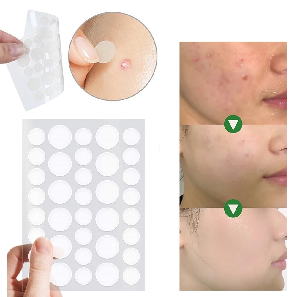 Jual Acne Pimple Patch ( Isi 36pcs ) Stiker Penghilang Jerawat Kempes ...