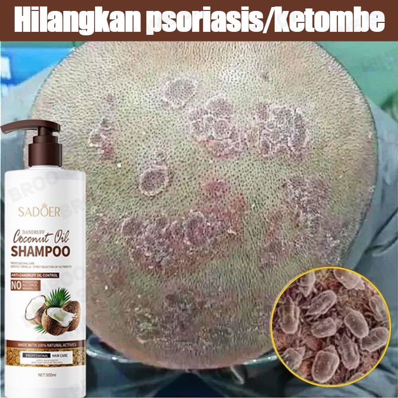 Jual Shampoo Anti Ketombe Anti Ketombe Dan Gatal Psoriasis Kulit Kepala