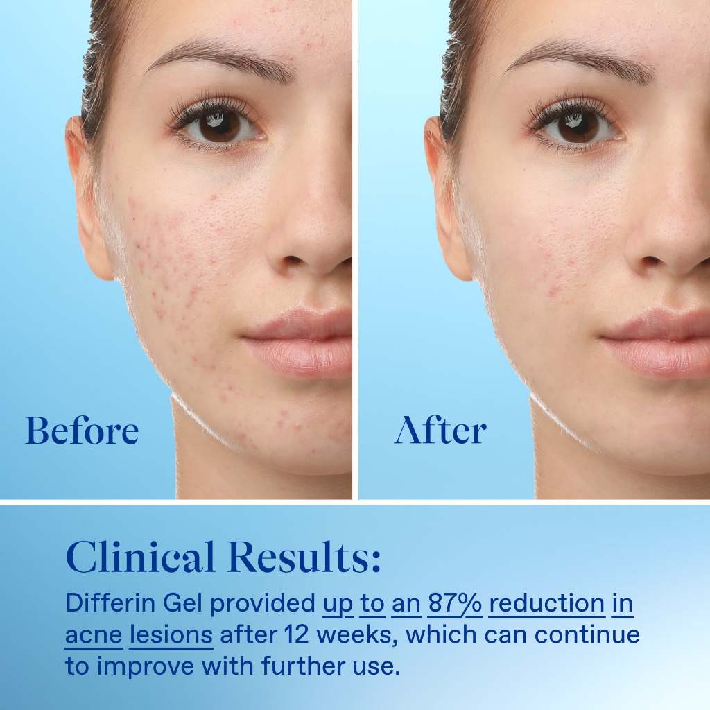 Jual [Ready Stock] Differin 0.1% Adapalene Gel Treatment| Differin Acne ...