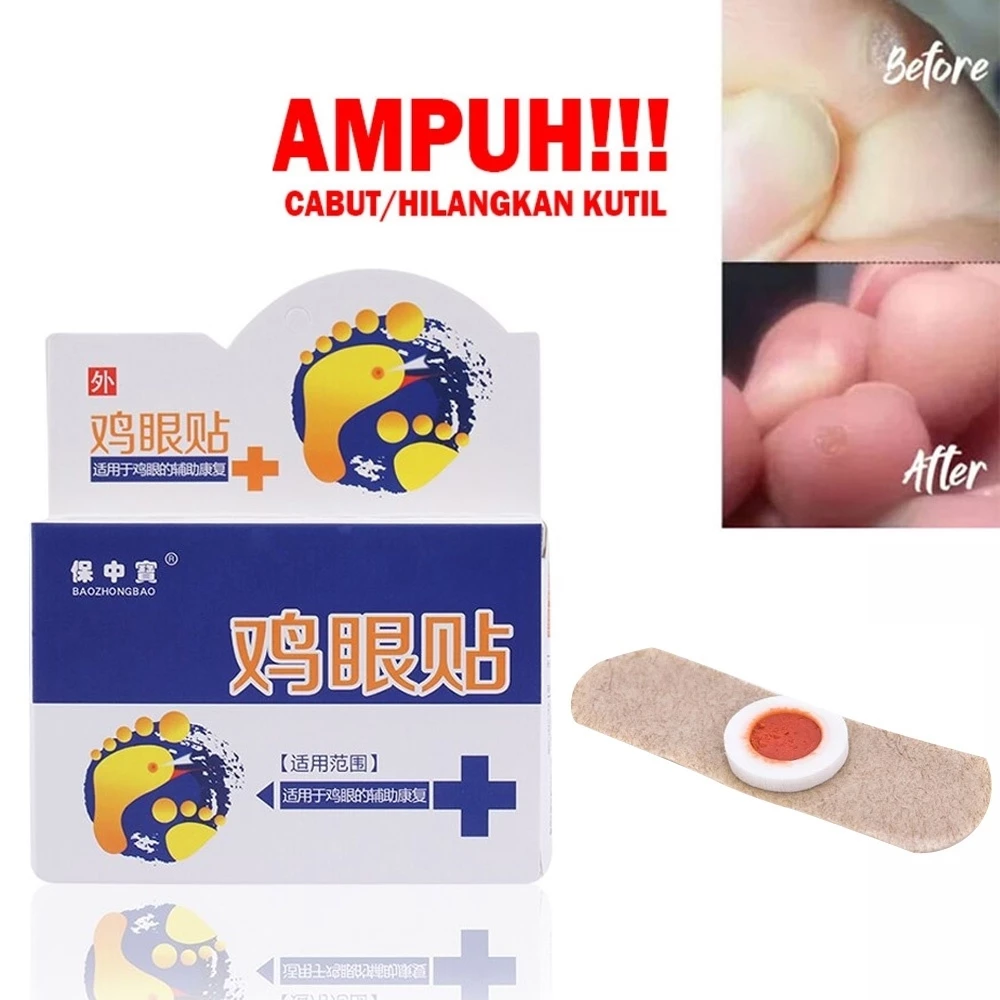 Plester Kutil Mata Ikan Mengobati Kutil Dan Kapalan Kaki | AutoStock