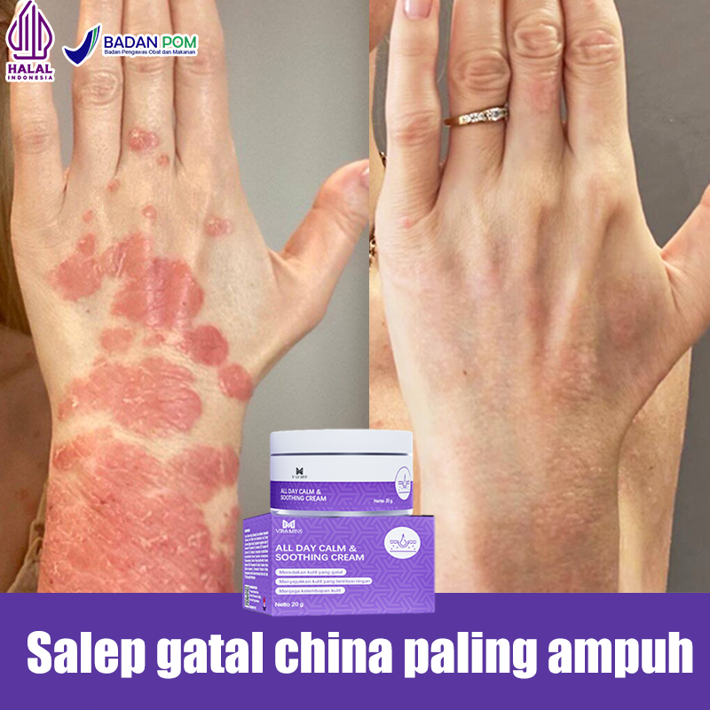 Salep gatal Salep gatal china paling ampuh Obat gatal selangkangan Obat eksim Obat kurap 20g salep gatal selangkangan Obat Gatal Kulit Salep Alergi Kulit Gatal Salep Eksim Jamur Dermatitis Psoriasis Eksim Jamur Kurap Alergi Kulit Cream