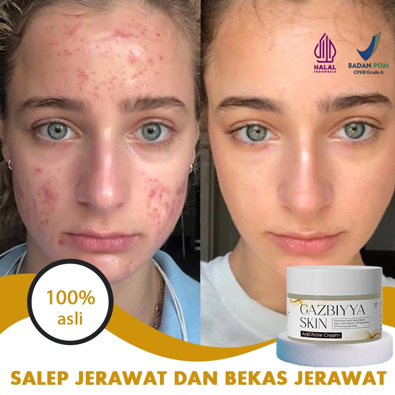 Jual 【BPOM】Penghilang bekas jerawat obat jerawat dan bekas jerawat