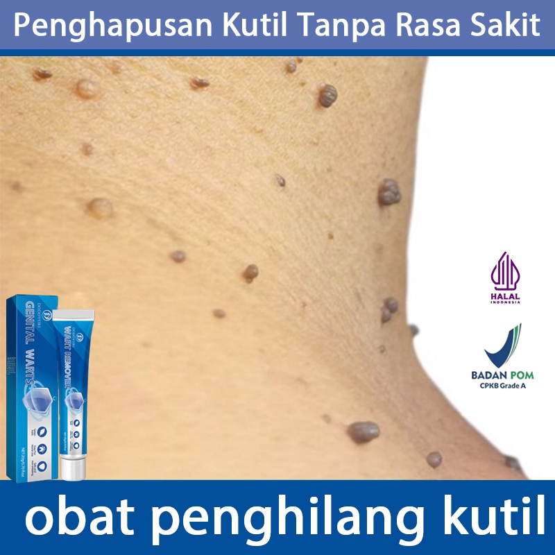 Jual Obat kutil salep kutil paling ampuh penghilang kutil 20g ...