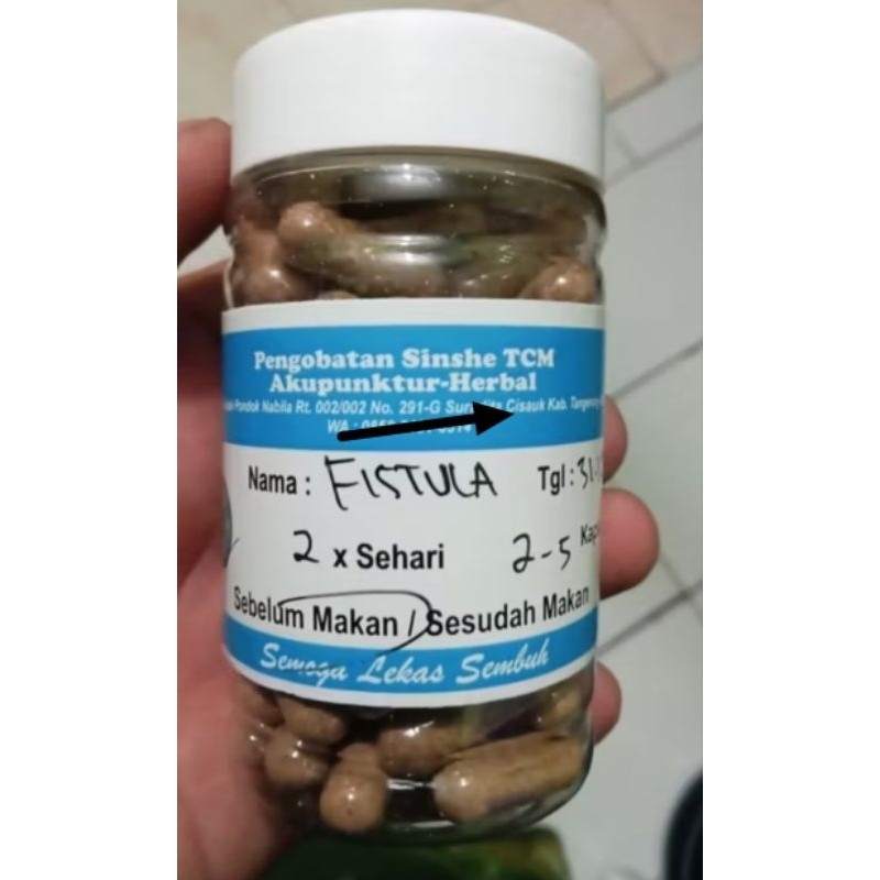 Jual Fistula Ani herbal Racikan Sinshe untuk kalangan sendiri | Shopee ...