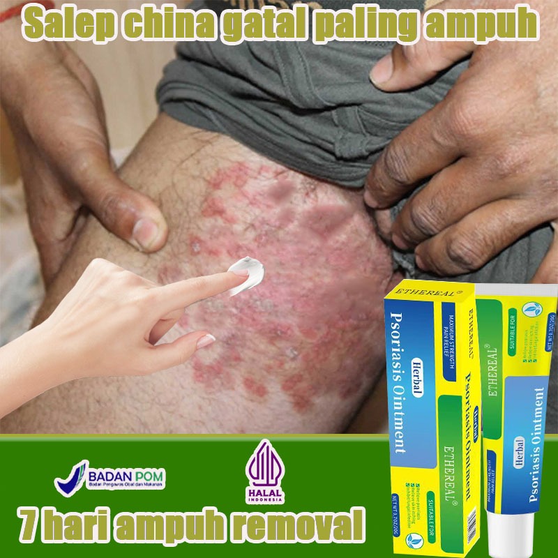 Jual Salep Eksim selangkangan gatal dan lecet 20g Obat Scabies obat ...