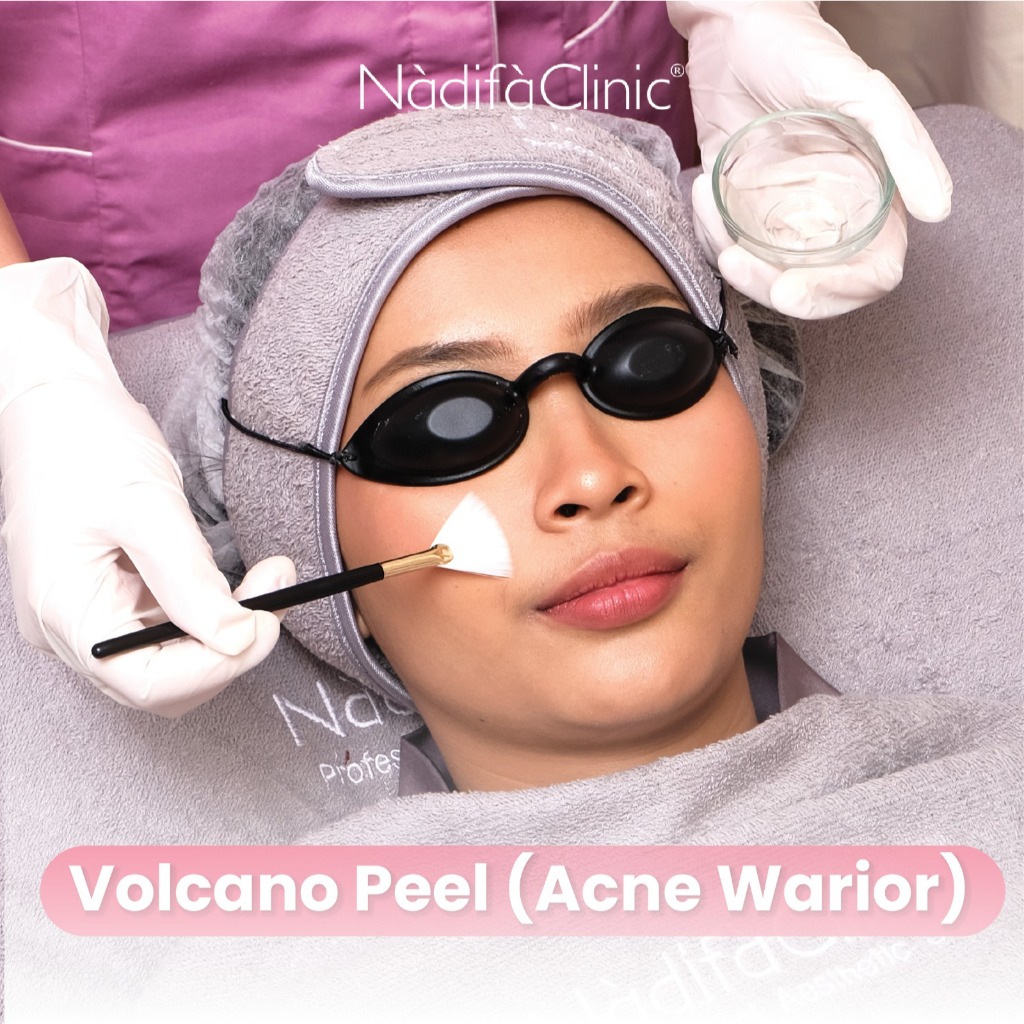 Jual TREATMENT VOLCANO PEEL ( ACNE WARIOR ) | Shopee Indonesia