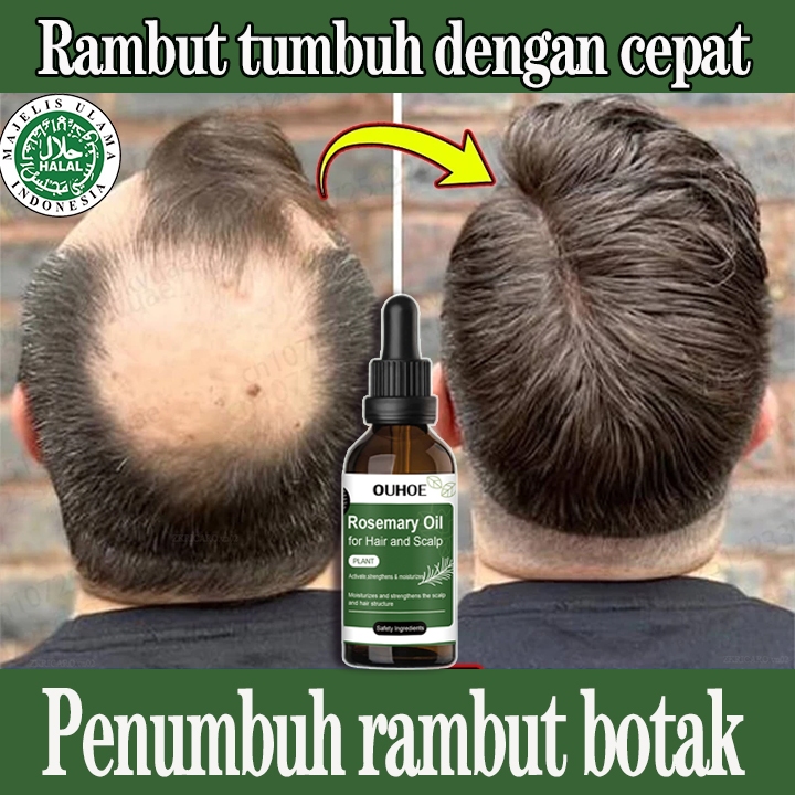 Jual Serum Penumbuh Rambut Botak Rosemary Oil Rambut Obat Penumbuh ...