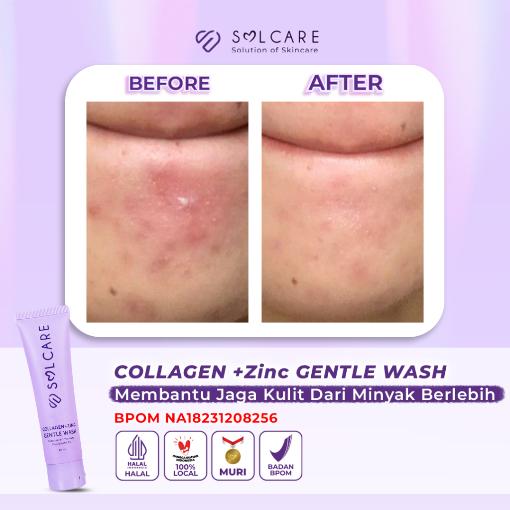 Jual BELI 4 DAPAT 13 Solcare Paket Basic Skincare | Shopee Indonesia