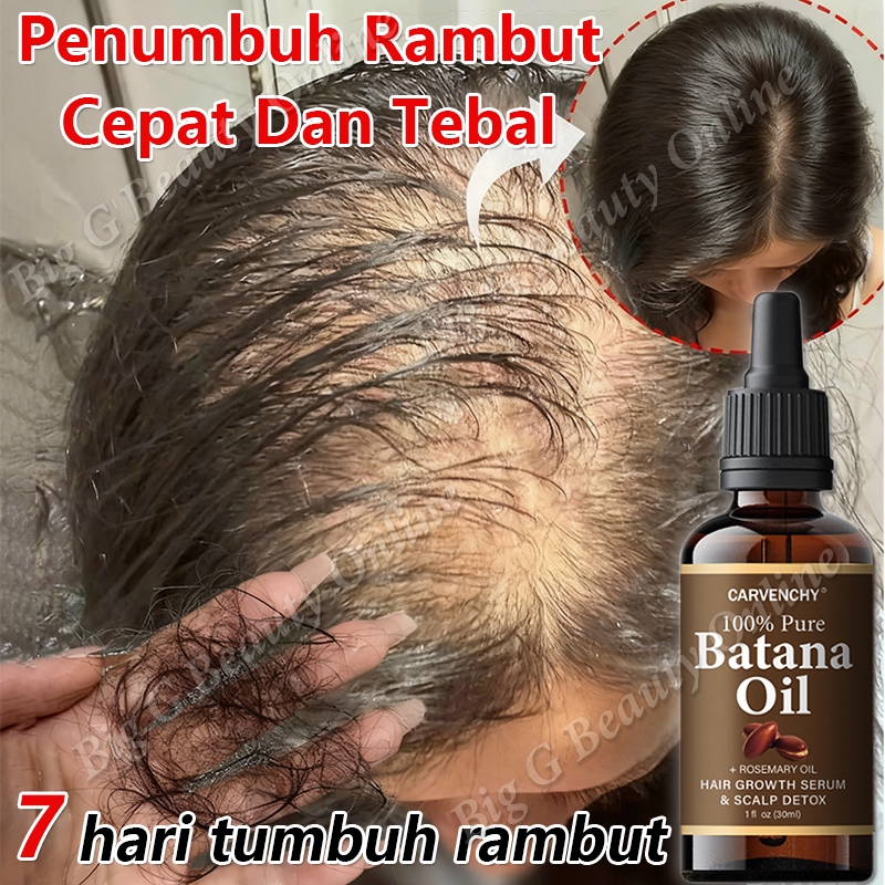 Jual Penumbuh Rambut Cepat Dan Tebal Hair Growth Serum Batana Oil ...
