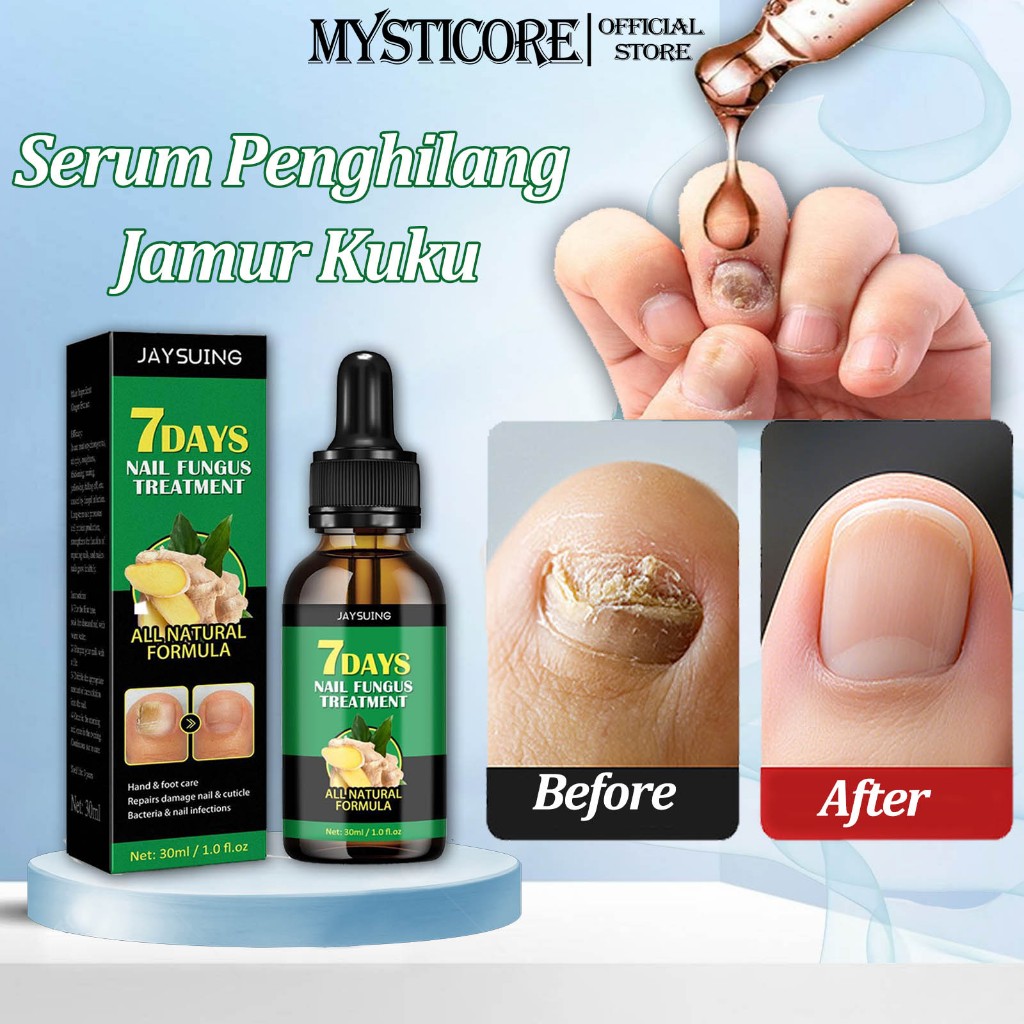Jual MYSTICORE Obat Jamur Kuku Obat kuku jamur dan rusak Perawatan Kuku