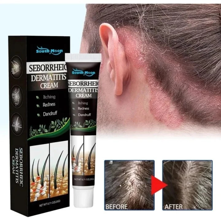 Jual Seborrheic Skin Cream Head Acne Pruritus Scalp Ringworm Skin ...