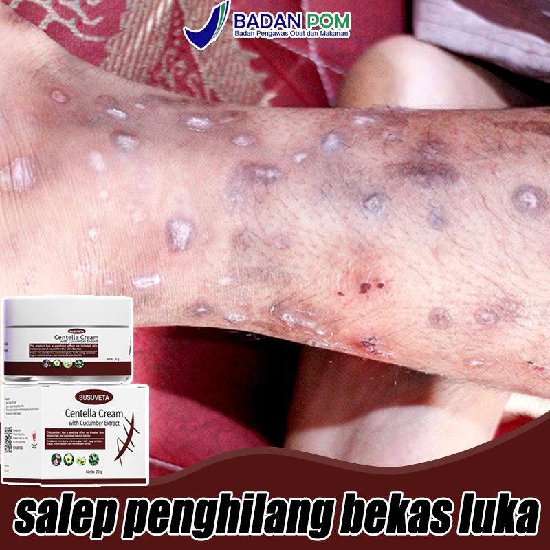 Jual SUSUVETA Penghilang bekas luka Cream penghilang bekas luka koreng ...