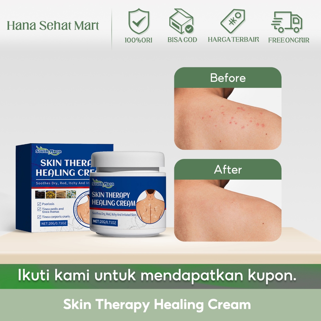 Jual South Moon Skin Therapy Healing Cream 20g Salep Psoriasis Untuk ...