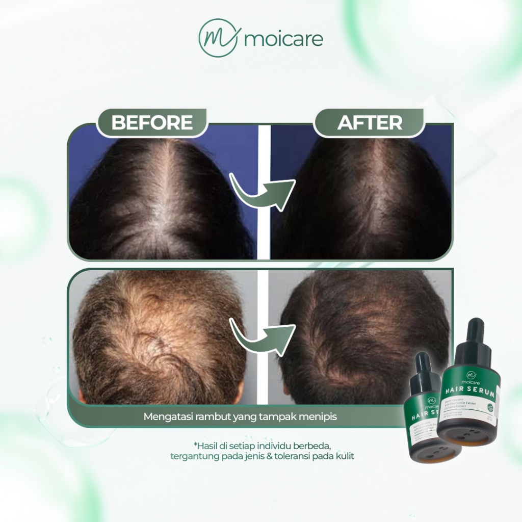 Jual Moicare Hair Serum - Anti Hair Fall Treatment With Biotin Keratin ...