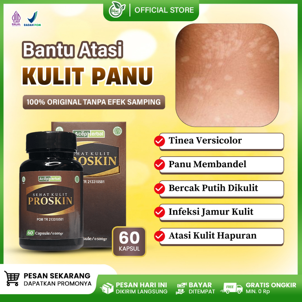 Jual Proskin 60 kapsul - Obat Panu Membandel, Kulit Panuan Di Tangan ...