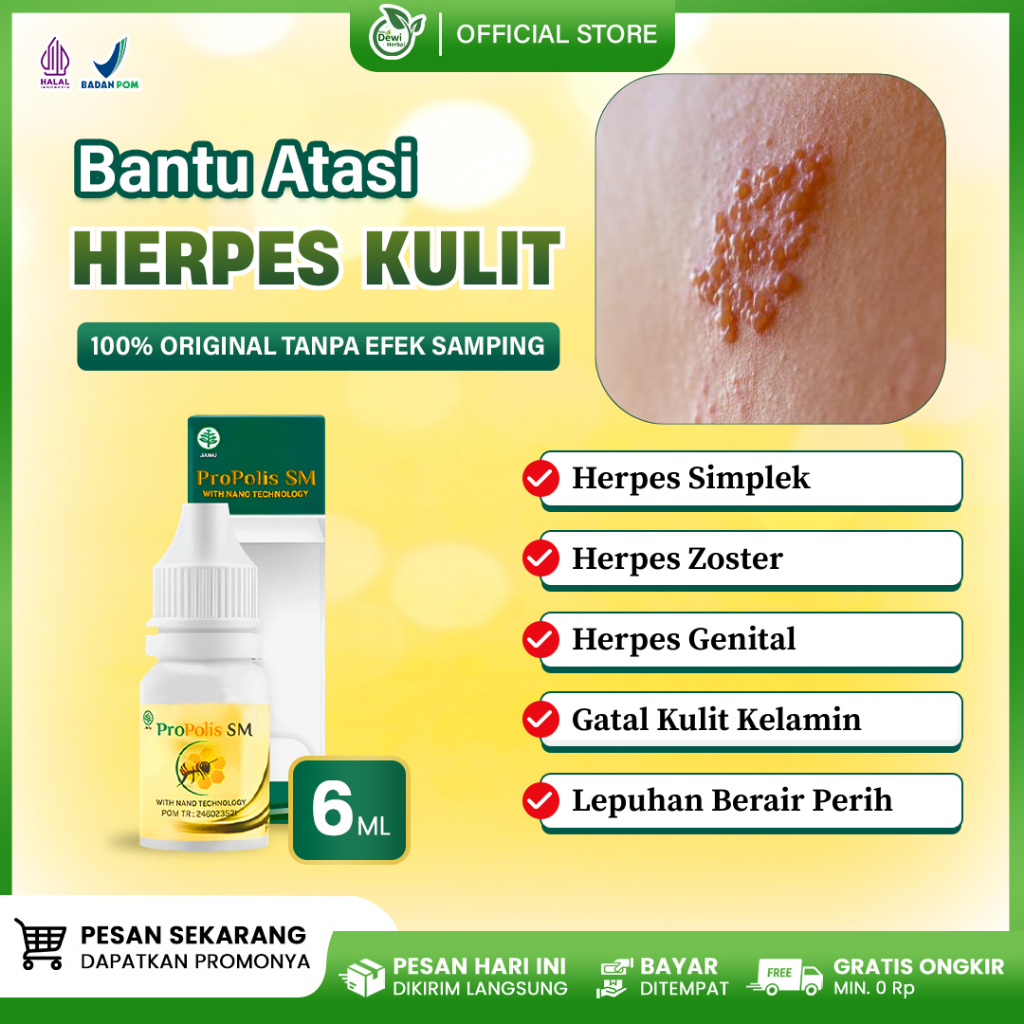 Obat Herpes Kulit, Herpes Simplek / Zoster / Genital, Gatal Kulit Kelamin & Selangkangan, Lepuhan Berair Terasa Nyeri Perih Panas