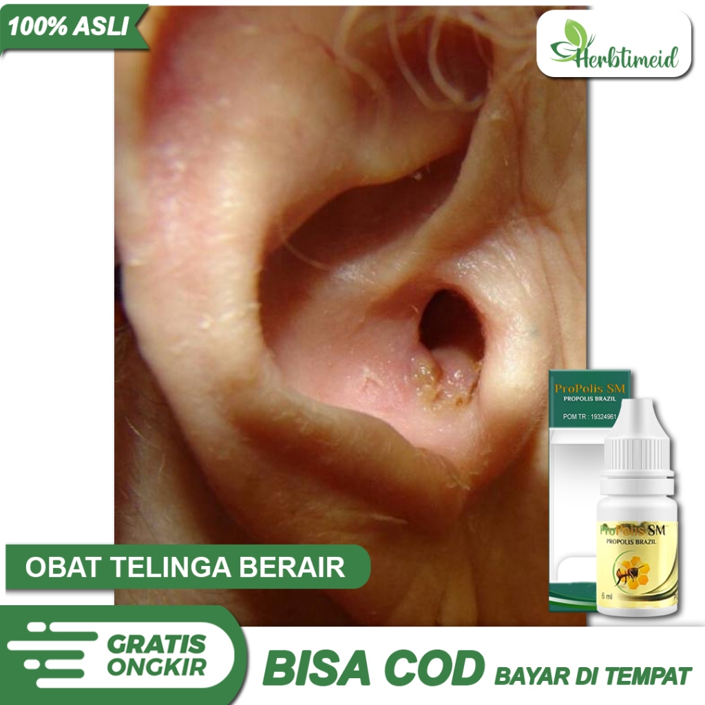 Jual Obat Tetes Telinga Gatal Berair Berdenging Budeg Berdengung Congek ...