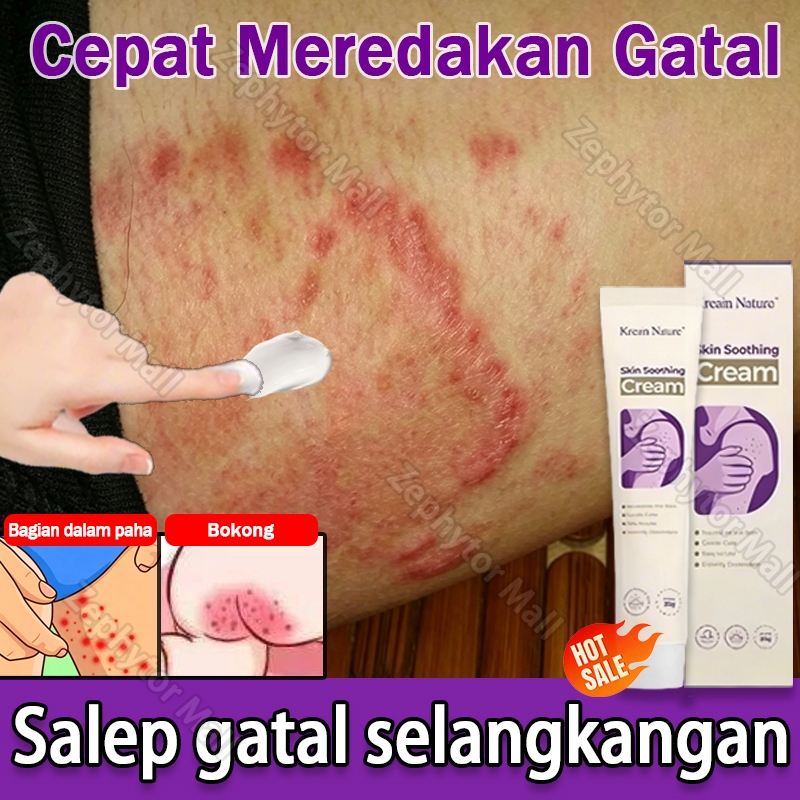 Jual Salep Gatal Selangkangan Salep Eksim Kering Dan Gatal Obat Gatal ...
