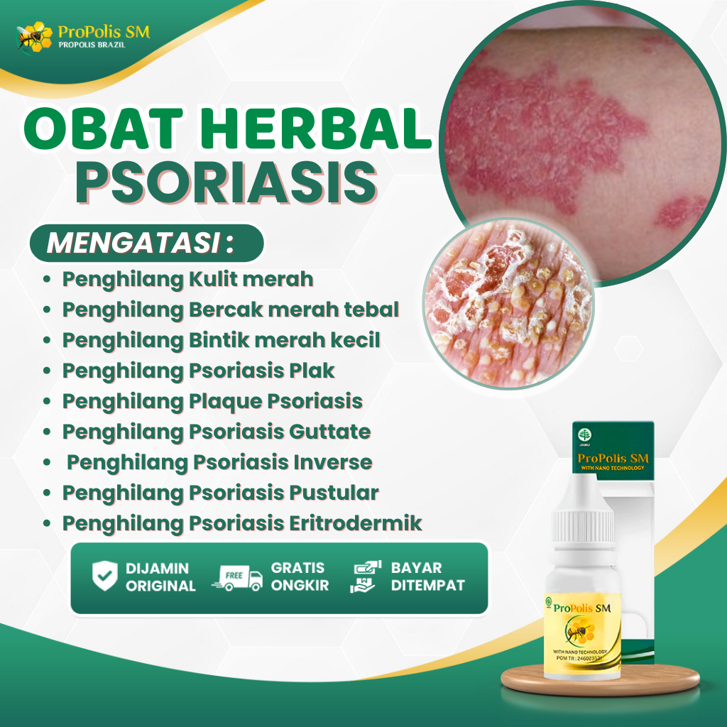 Jual Obat Herbal Penghilang Kulit merah Propolis SM Original Ekstrak ...