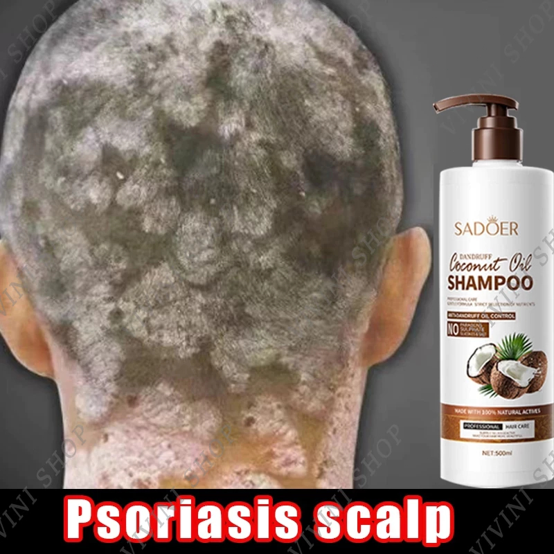 Jual Shampoo psoriasis Shampoo anti ketombe 500ml Penghilang ketombe