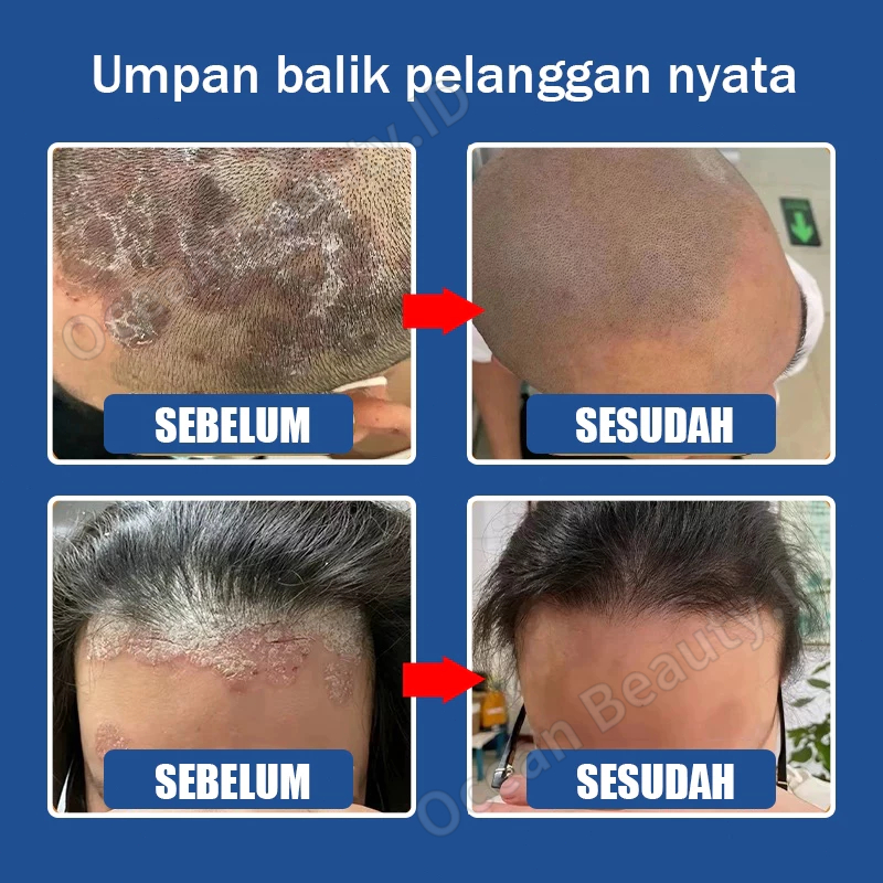 Jual Obat Ketombe Penghilang Ketombe Dermatitis Seboroik Semprotan ...
