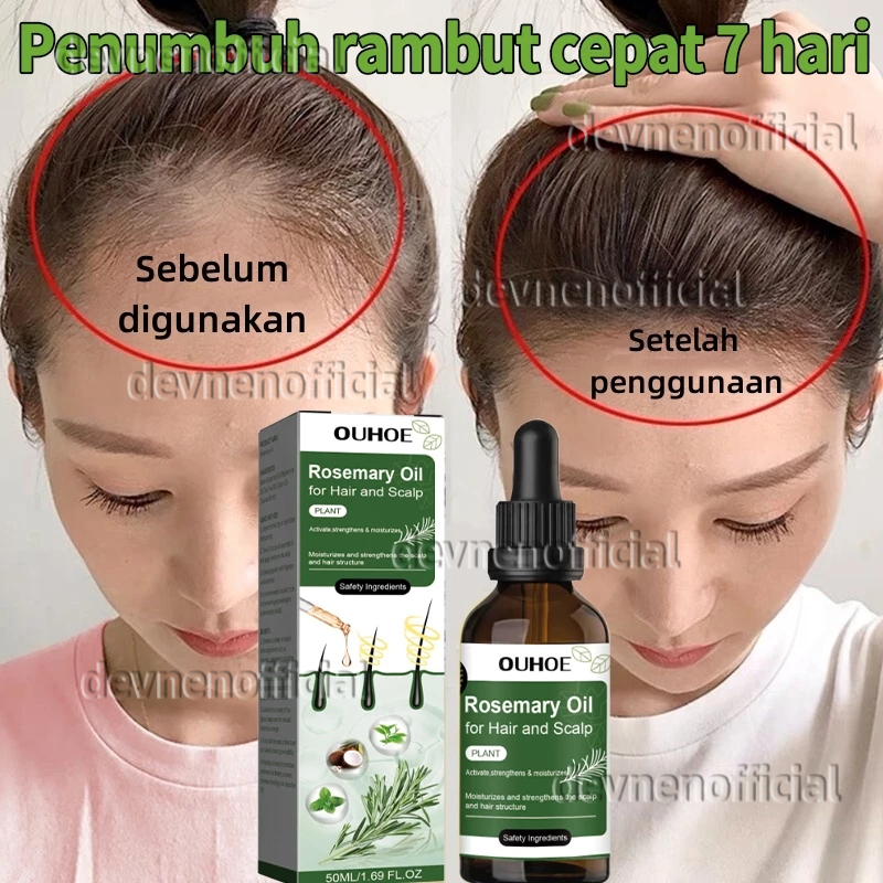 Jual penumbuh rambut cepat dan tebal serum rambut rontok Hair growth ...