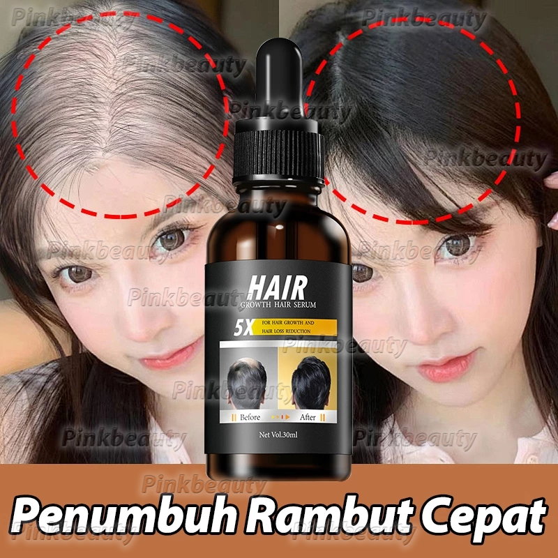 Jual Serum Penumbuh Rambut Botak Penumbuh Rambut Cepat dan Tebal Hair ...