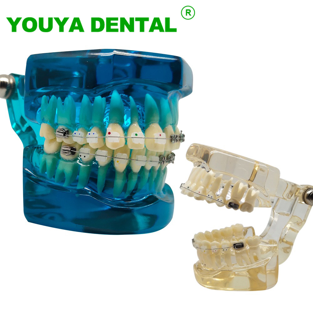 Jual Dental Orthodontic Treatment Model With Ceramic Metal Brackets ...