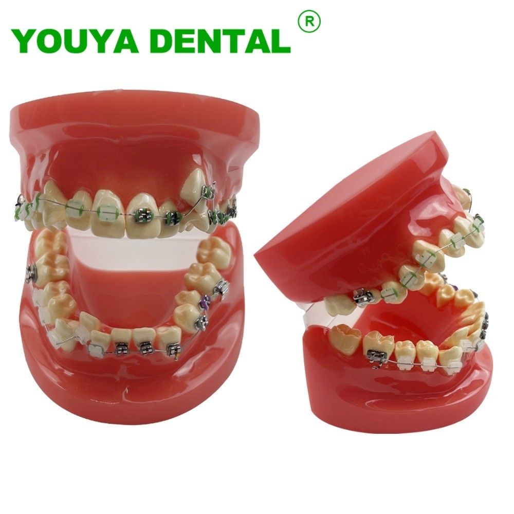 Jual Orthodontic Teaching Model Dental Teeth Treatment Model With Metal ...