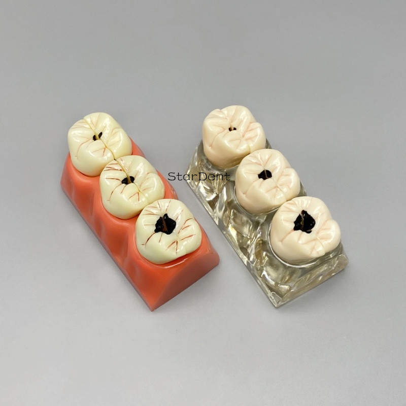 Jual Dental Model Decayed Dentures Caries Disease Process Model Tooth ...