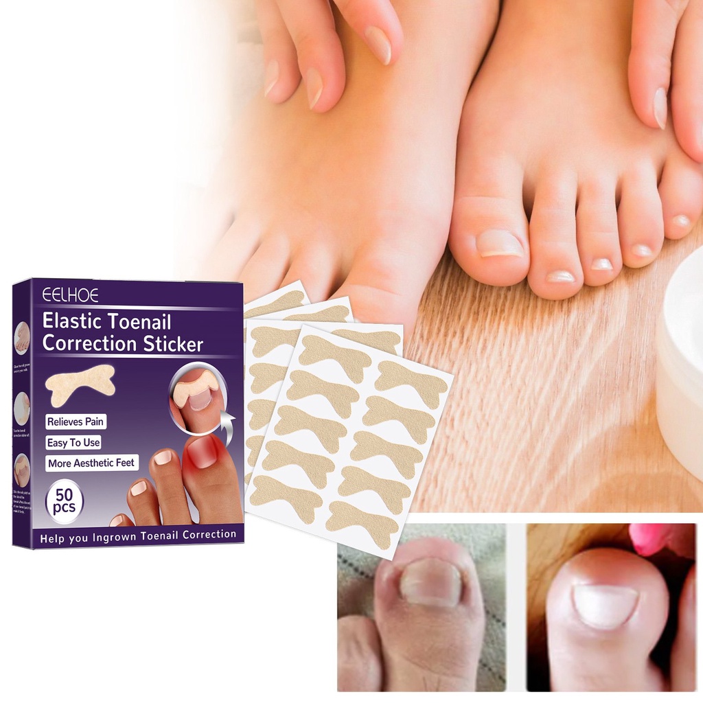 Jual HUMMI X EELHOE Stiker Korektor Kuku Kaki Adhesive Ingrown Toenail ...