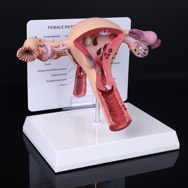 Jual NEW Biology Teaching, Anatomy Lesion Uterus Model, Human Female ...