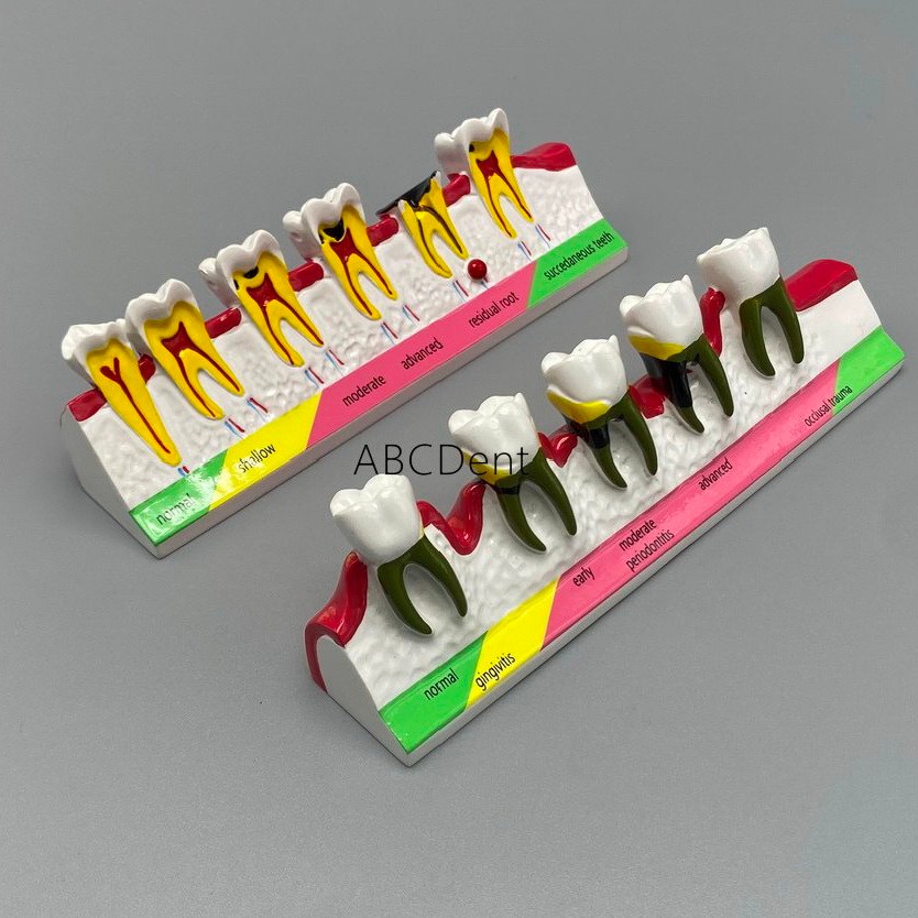 Jual Dental Teeth Dentoform Models Caries Disease Periodontal Diseases ...