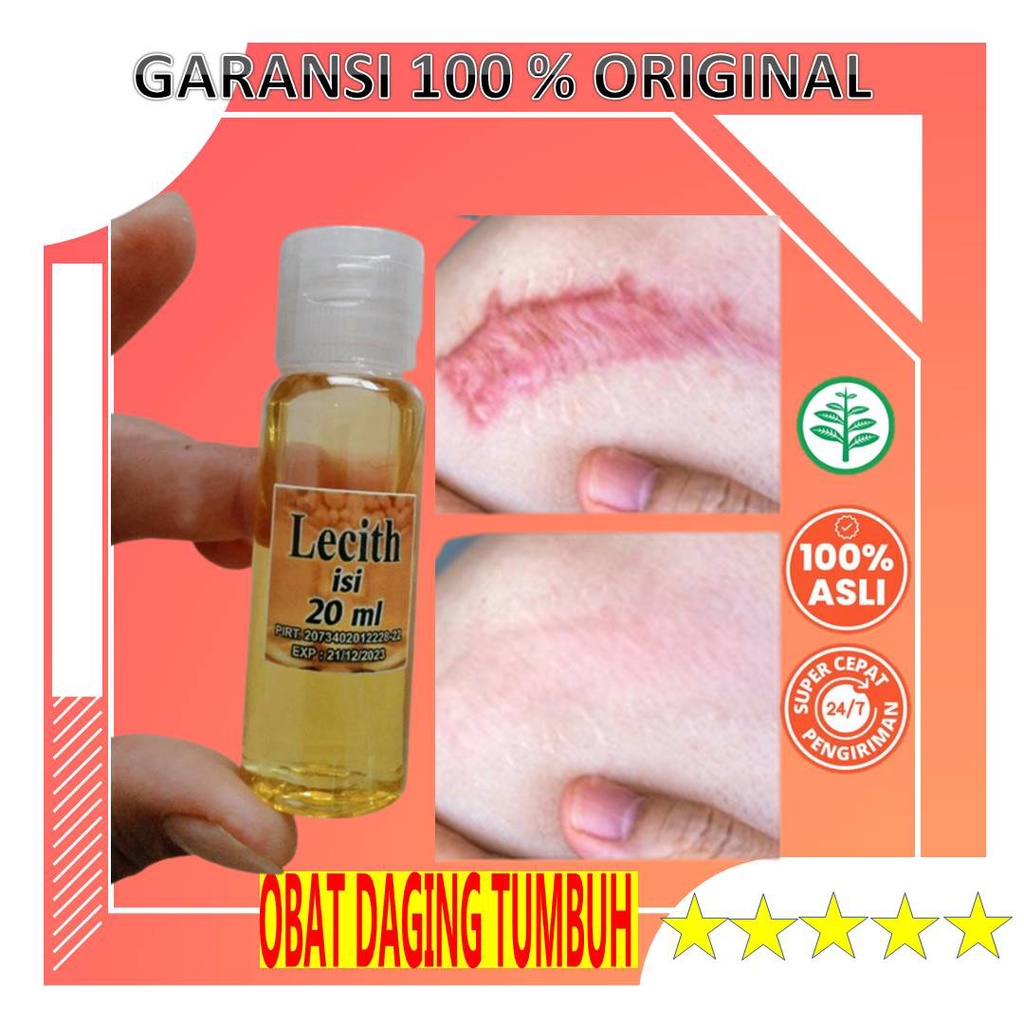 Jual Minyak Obat Penghilang Keloid Yang Sudah Lama Luka Bakar Bagus Scar Krim Keloid Salep Serum