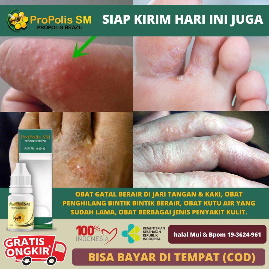 Jual Obat Gatal Berair Di Jari Tangan Dan Kaki Obat Gatal Penghilang Bintik Bintik Berair Obat 0112