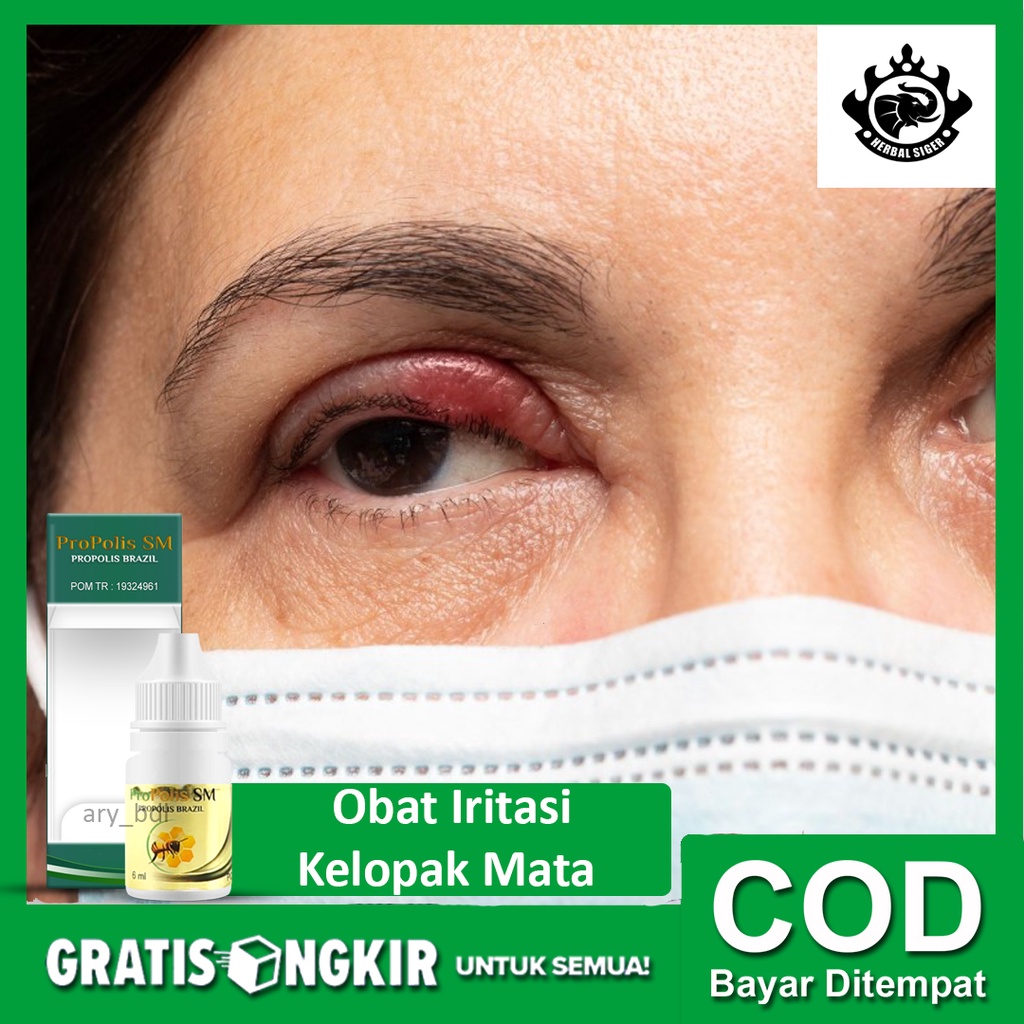 Jual Obat Herbal Iritasi Kelopak Mata Peradangan pada Kelopak Mata