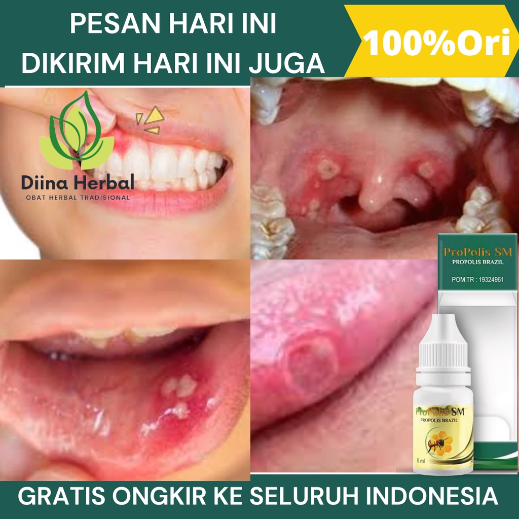 Jual Obat Sariawan Di Bibir Atasi Bau Mulut Tak Sedap Bibir Pecah Pecah Panas Dalam Radang