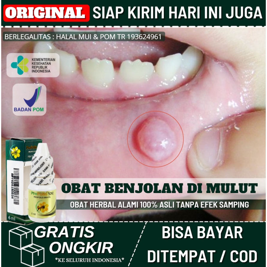 Jual Obat Herbal Benjolan Mucocele Benjolan Di Bibir Mulut And Lidah