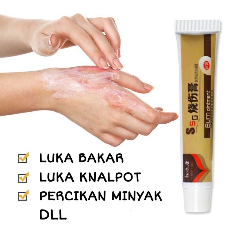 Jual Mbappe Salep Obat Luka Bakar Kena Air Atau Minyak Panas Dan Keloid Shopee Indonesia 