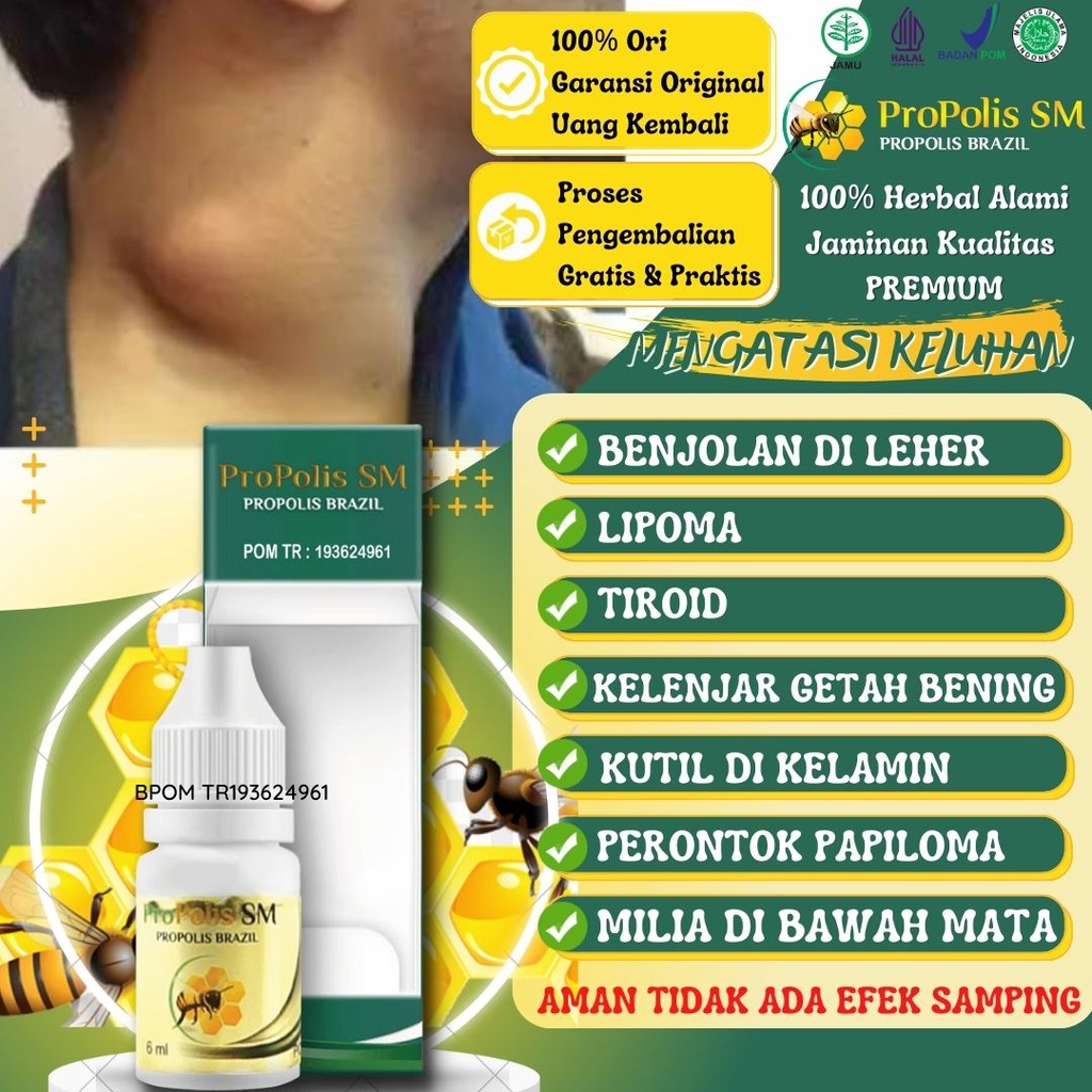 Jual Obat Penghilang Benjolan Di Leher Lipoma Gondok Tiroid Kelenjar ...