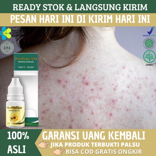 Jual Propolis SM - Obat Jerawat di Punggung, Di Dada, Di Wajah, Gatal ...