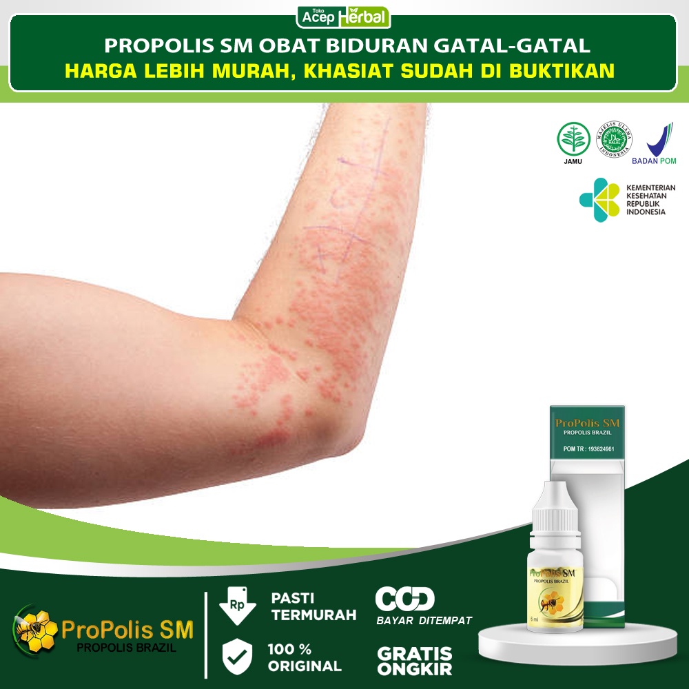 Jual Obat Biduran Propolis Sm Alergi Bintik Bintik Merah Biduran Menahun Kaligata Scabies Kulit 6916