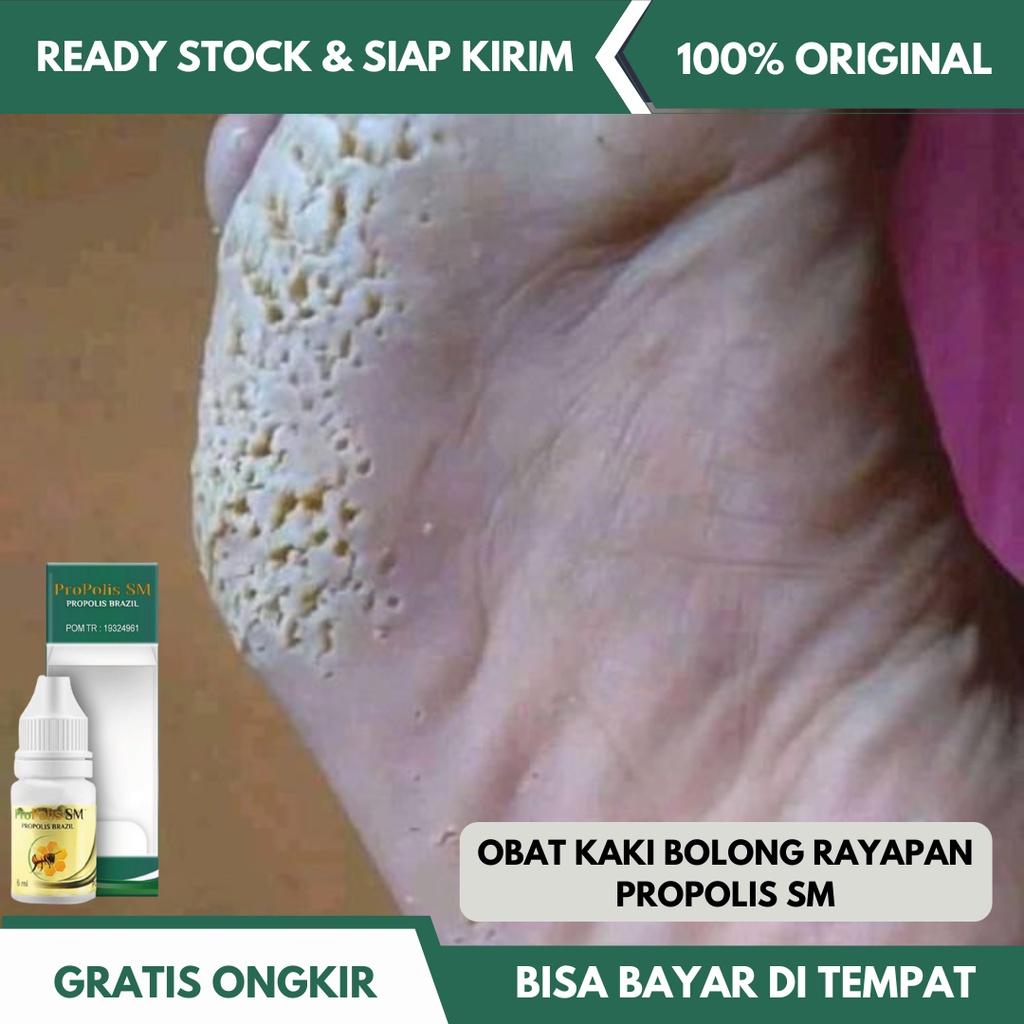 Jual Obat Kaki Bolong Bolong Telapak Kaki Rayapan Rorombeheun Obat